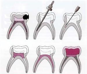 методы лечения пульпита