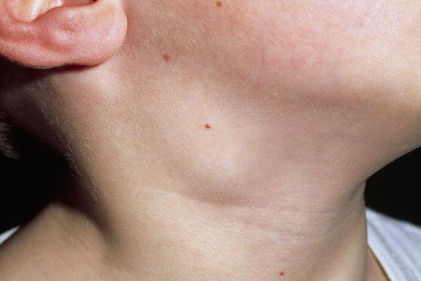 воспаление лимфоузлов на шее у ребенка