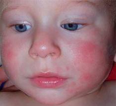аллергия у ребенка до года
