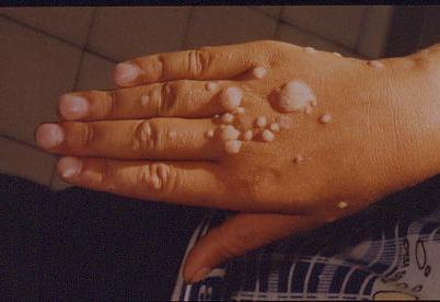 папилломавирусная инфекция лечение