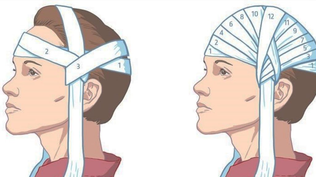 Помощь при ранении головы. Перевязка головы чепец. Наложение повязки чепец. Чепец повязка чепец. Давящая повязка при травме головы чепец.