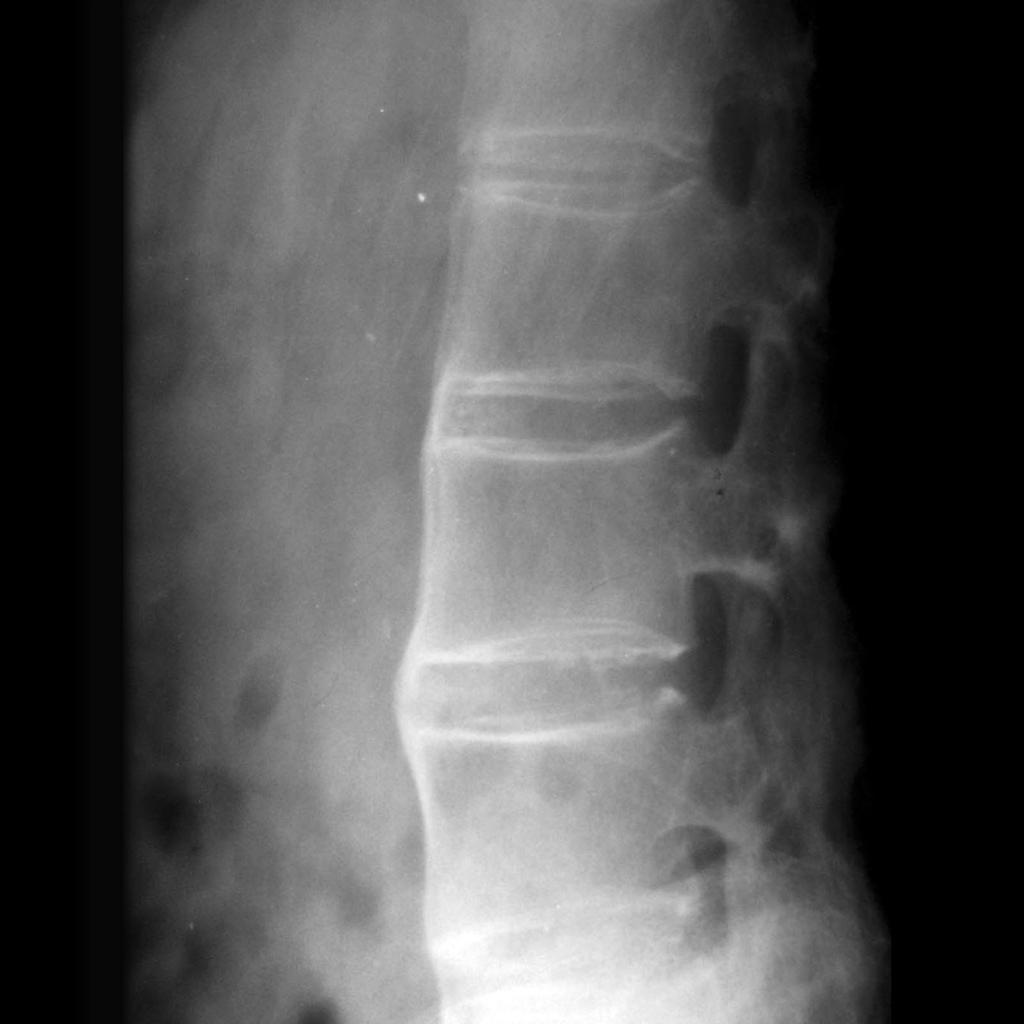 Болезни Бехтерева (анкилозирующего спондилита) рентген