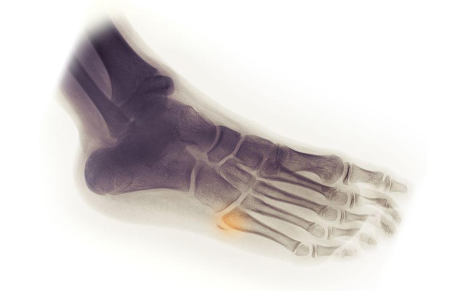 Боль в области плюсневых костей стопы