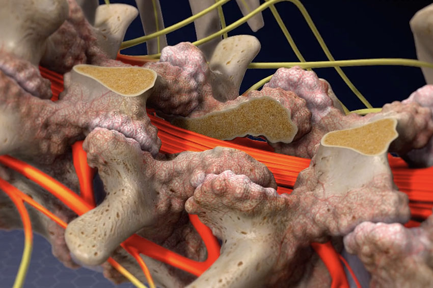 vertebral laminectomy