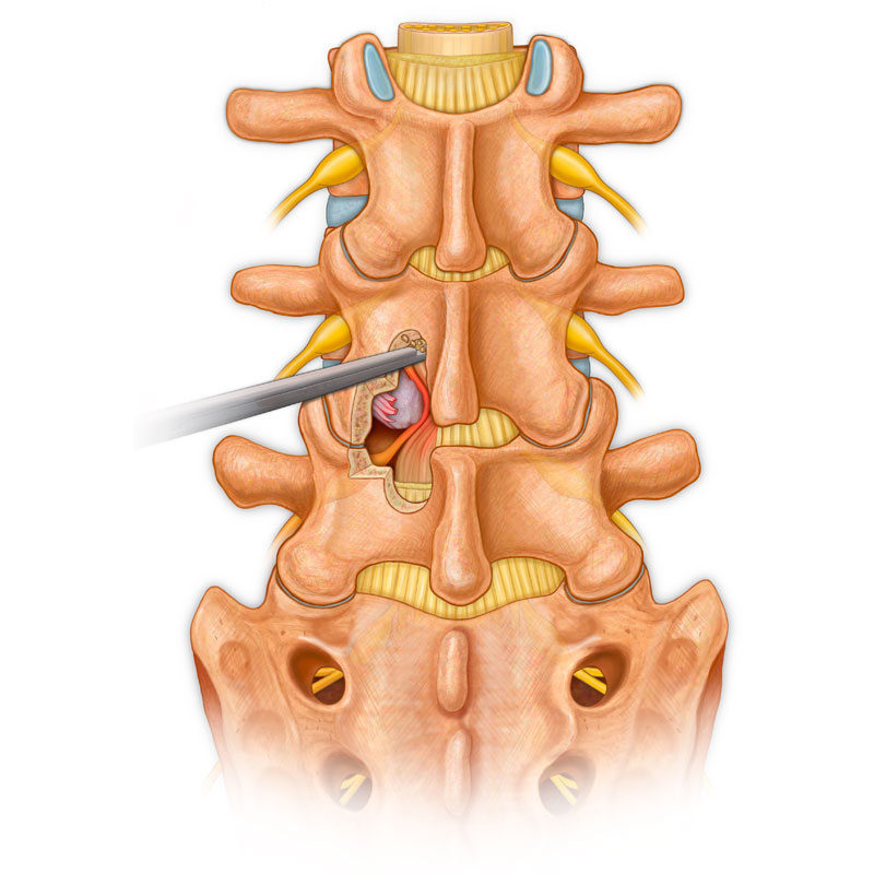 fixation laminectomy