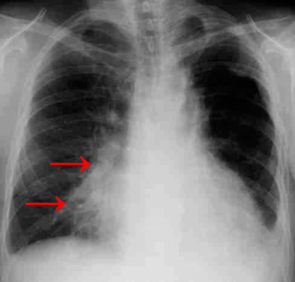 Рентген легких при пневмонии фото у взрослого