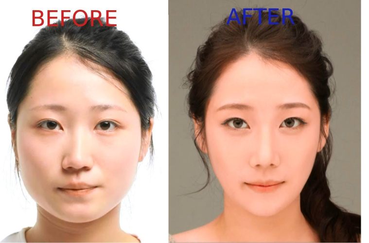 Результат до и после операции в Корее