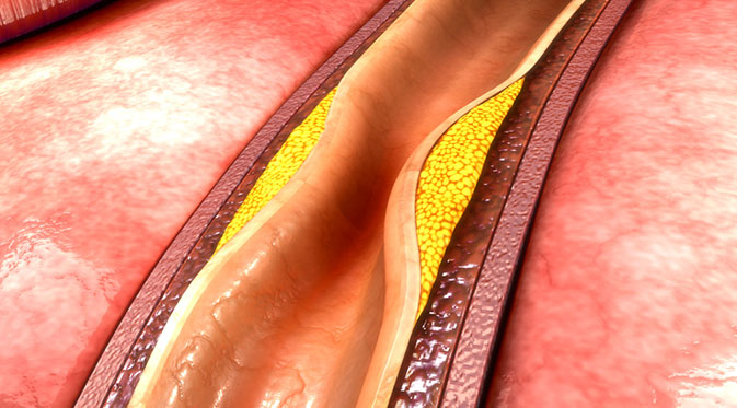 Narrowing of the walls of blood vessels