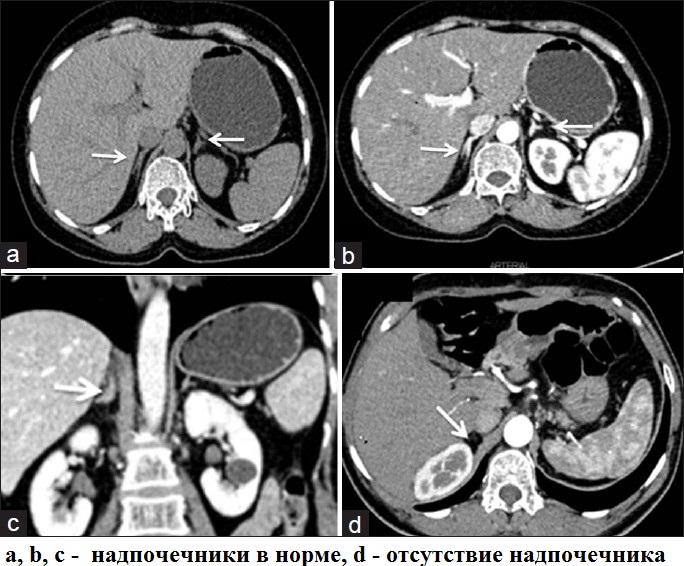 Кт надпочечников без контраста. Кт мрт аденома надпочечника. Контрастирование почек кт. Опухоли надпочечников на кт. Кт почек с контрастированием норма.
