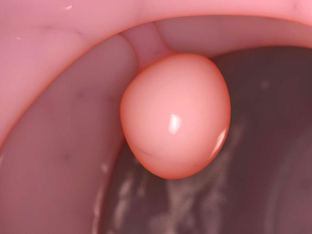 uterine polyp