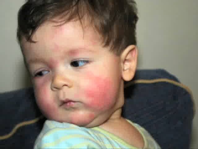 Как выглядит аллергия у детей фото