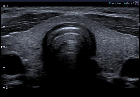 снимок щитовидной железы