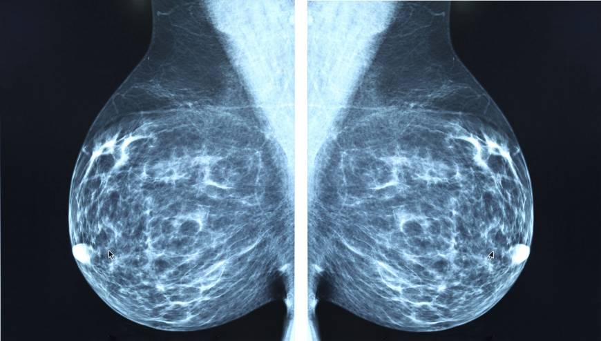 Mammography of the mammary glands