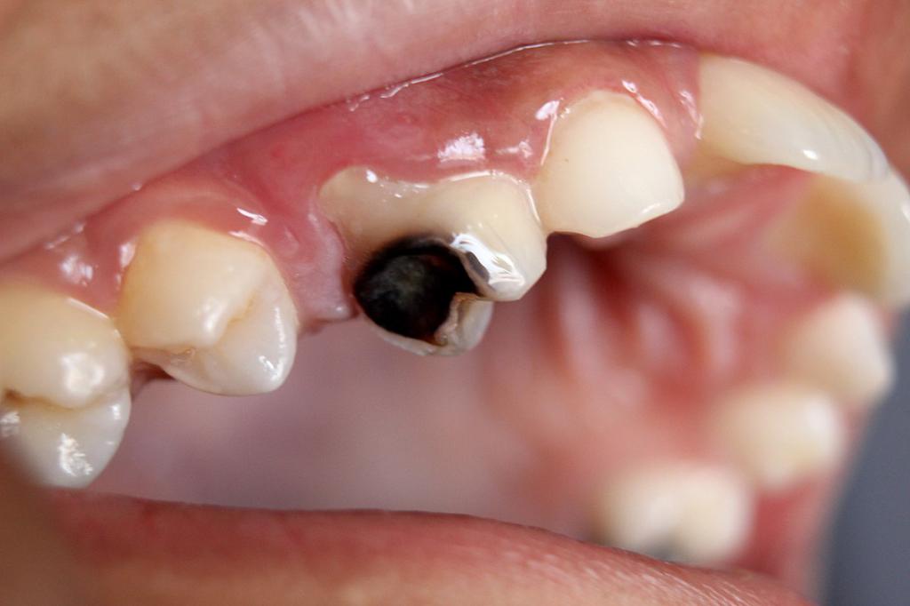 Опасность кариеса зубов