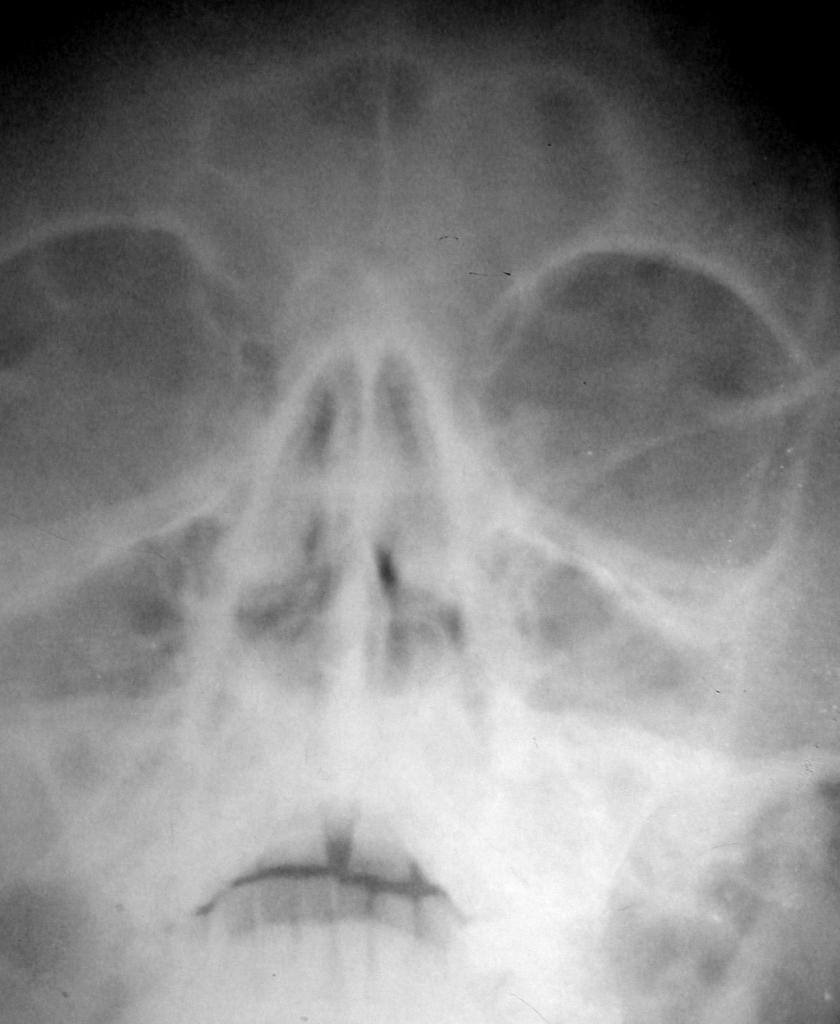 Двухсторонний верхнечелюстной синусит рентген