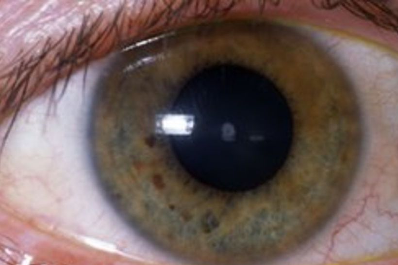 ядерная катаракта глаз у пожилых
