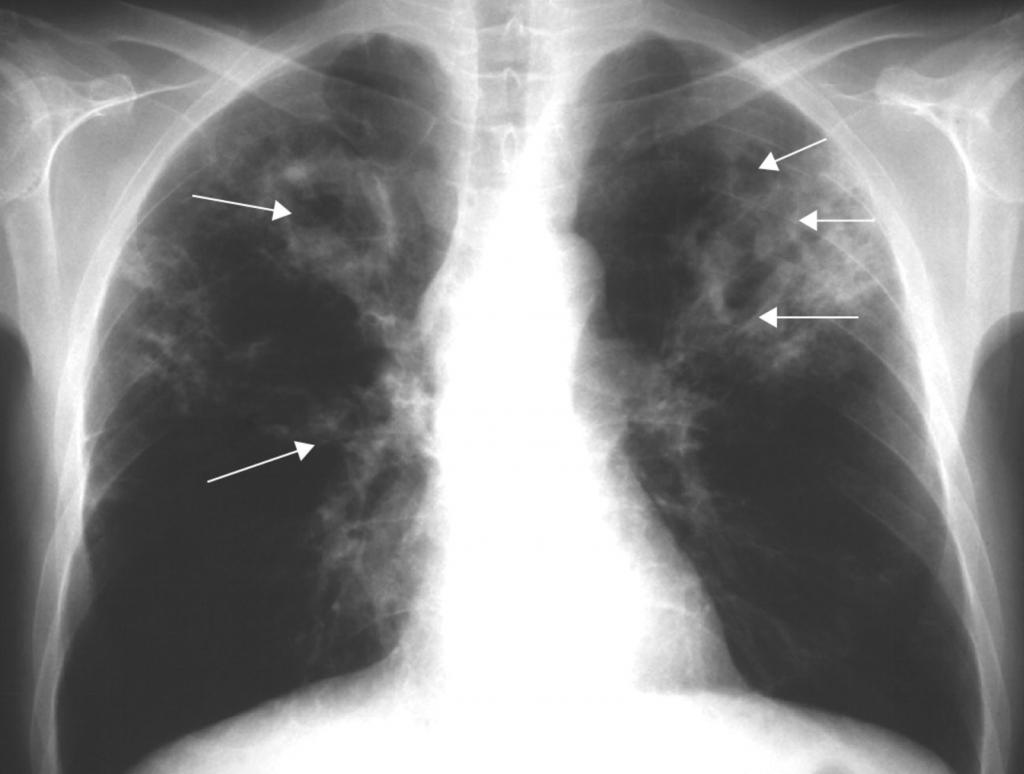 Фиброзно очаговый туберкулез рентген