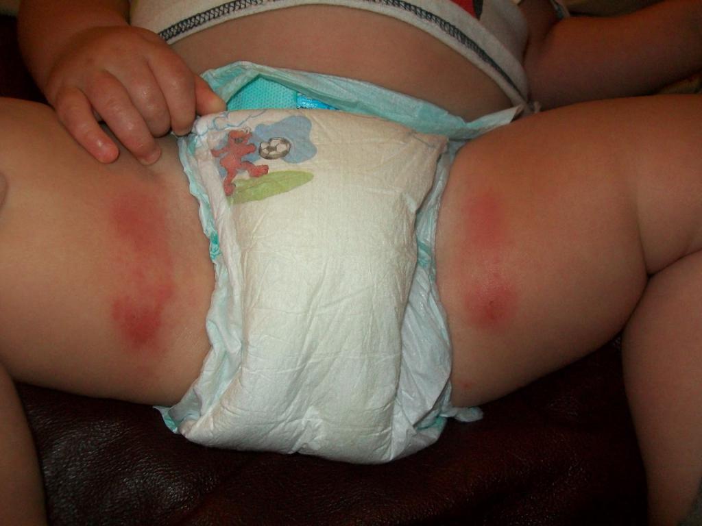 How to treat diaper rash