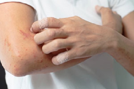 Itchy rash on the hands