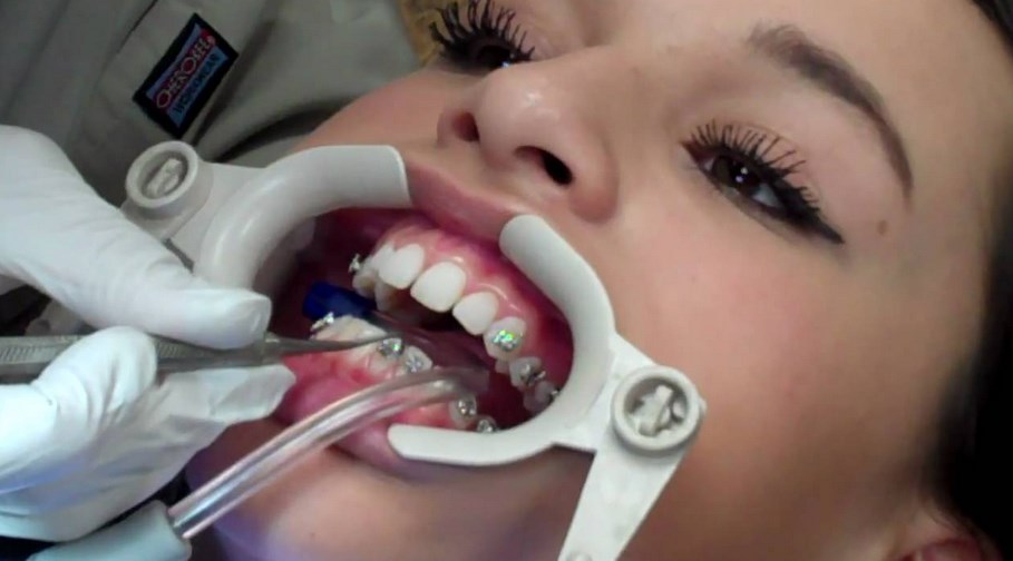 выравнивание зубов отзывы