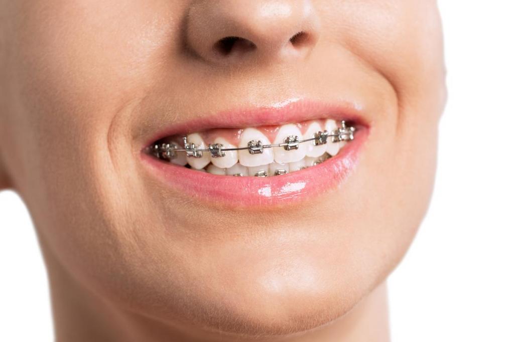 отзывы о металлические брекеты для исправления прикуса зубов