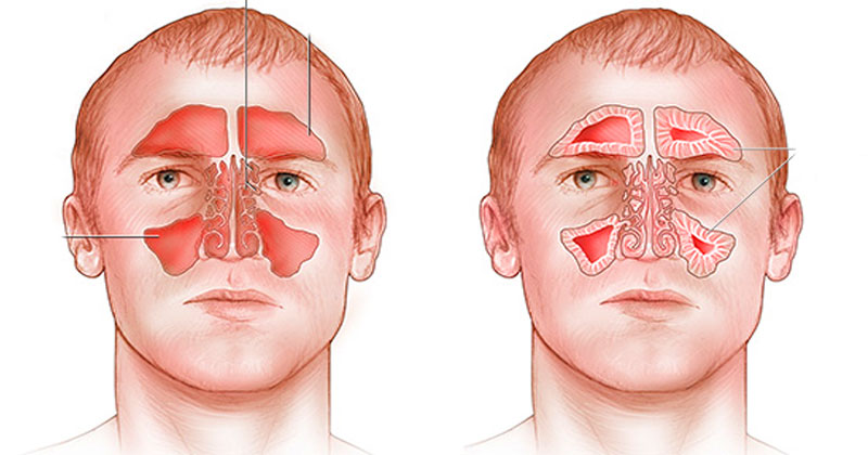 Синусит можно греть нос. Пазухи носа анатомия гайморит. Синусит – воспаление придаточных пазух нос. Синусит верхнечелюстной пазухи.