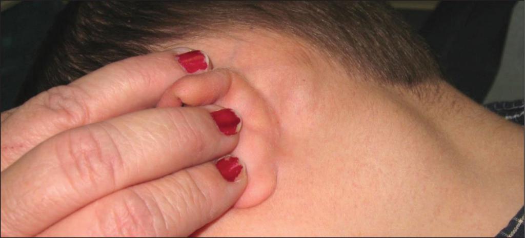 Inflammation behind the ear