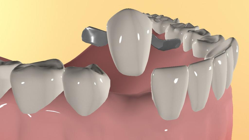 Зубной протез