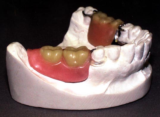 Denture clasp