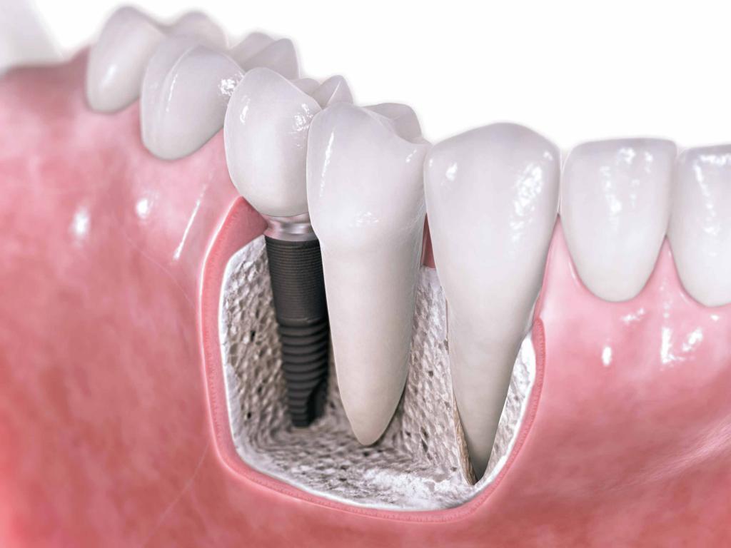 Зубной имплант Alpha bio