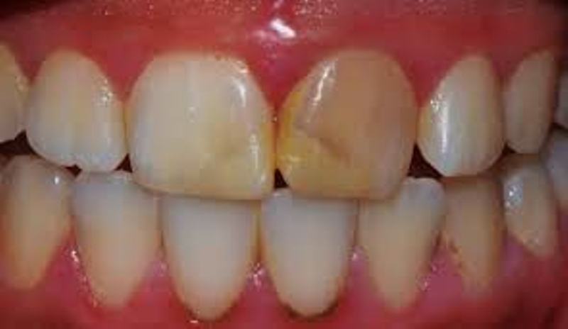 внутриканальное отбеливание зубов отзывы