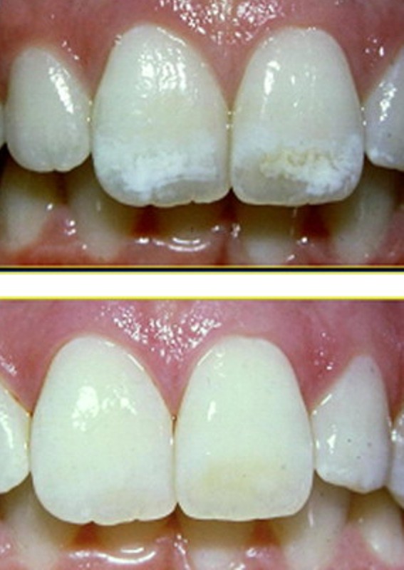 плюсы и минусы метода внутриканального отбеливания зуба