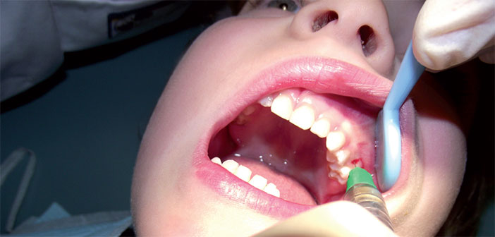 интралигаментарная анестезия в стоматологии техника проведения