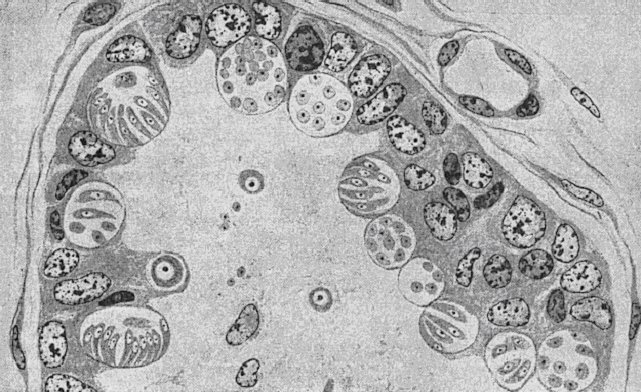 Ameriosis histology