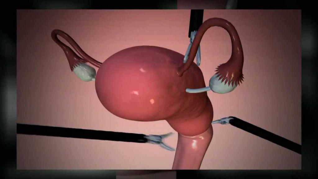 Extirpation of the uterus