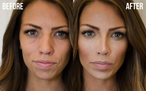 Результат исправления формы носа до и после