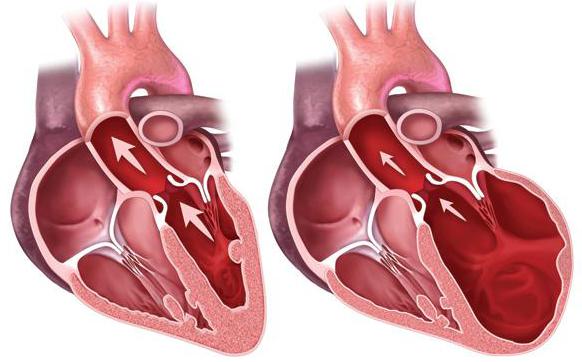 Что значит увеличение левого желудочка сердца?