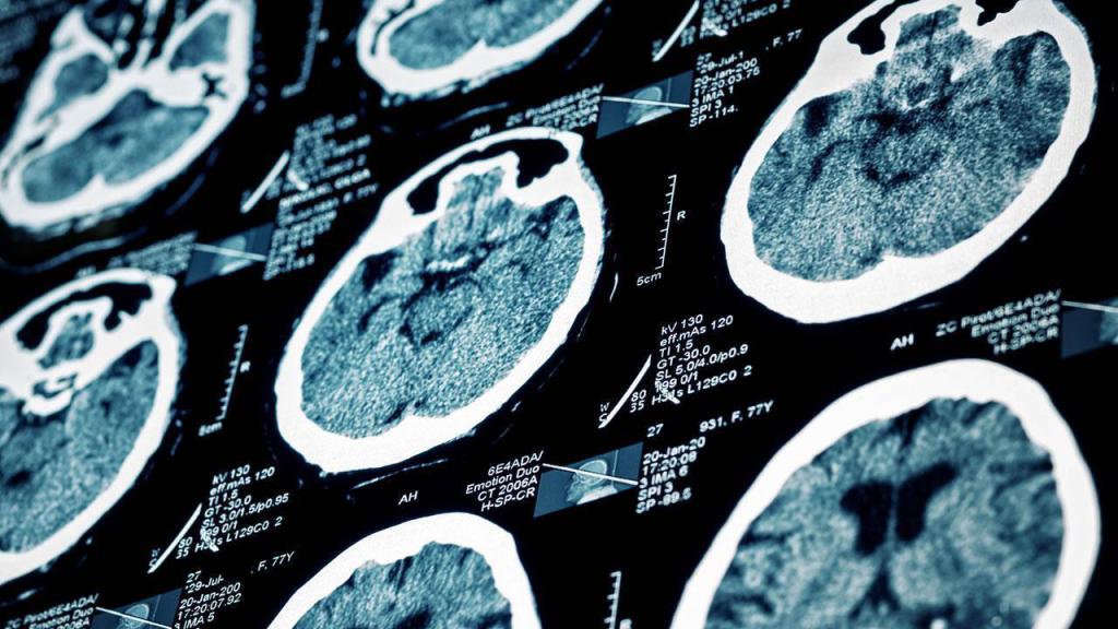 Инсульт кома выживают. Исследование ткани головного мозга. Шансы выжить после инсульта.