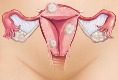 Боли внизу живота во время менструационного цикла