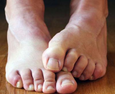 Лечение грибка ногтей домашними методами. Как вылечить грибок ногтей на ногах в домашних условиях йодом и не только. Нашатырный спирт и перекись водорода