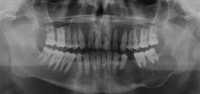 Как болят зубы при раке челюсти thumbnail