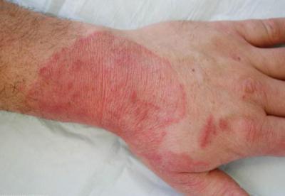 микозы кожи лечение