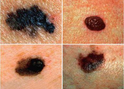 меланома кожи прогнозы жизни 4 стадия фото 