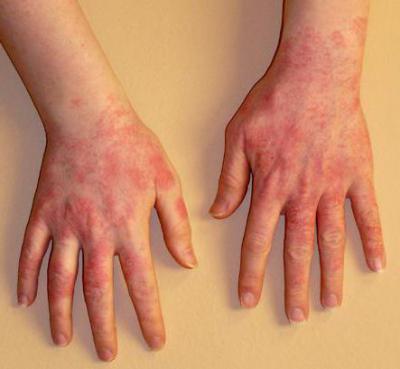 аллергия на латекс у женщин симптомы