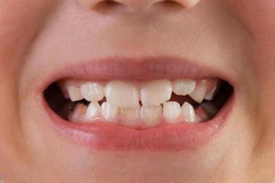 подвижность зубов