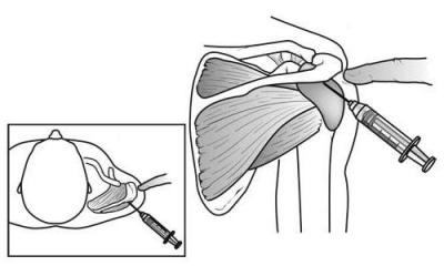 Изображение - Пункция плечевого сустава топографическая анатомия 1898323