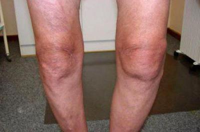 Изображение - Артроз коленных суставов код 2028241