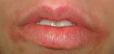 Сухая кожа вокруг рта: причины, лечение, запись к врачу