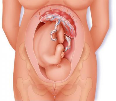 Отслоение плаценты при родах. Отслойка плаценты: симптомы, причины на ранних и поздних сроках, лечение, последствия