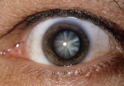 Как действовать при травматической катаракте. Контузия хрусталика и посттравматическая катаракта: признаки, диагностика, лечение Поврежден хрусталик глазной чем лечить
